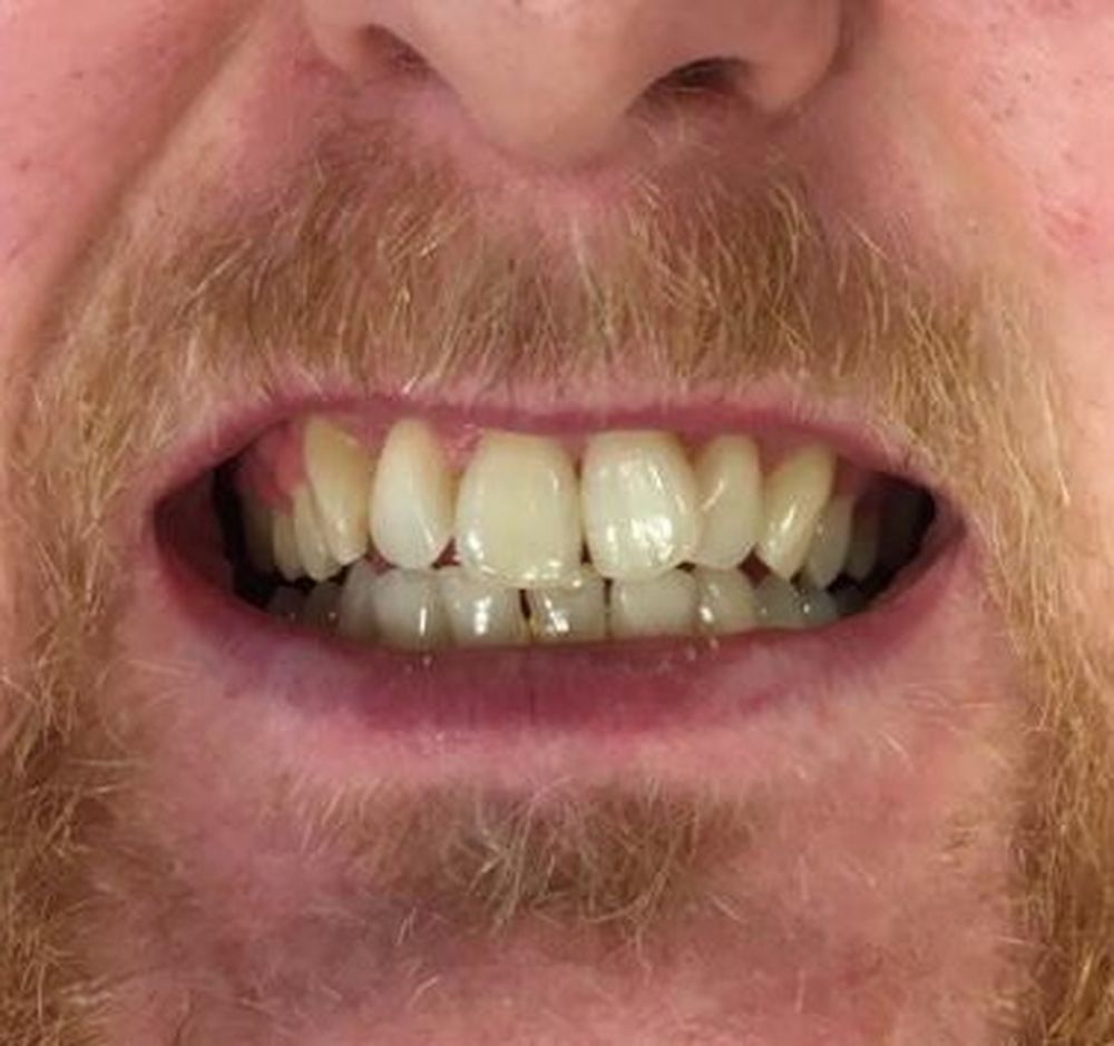 karl-6-month-braces-before